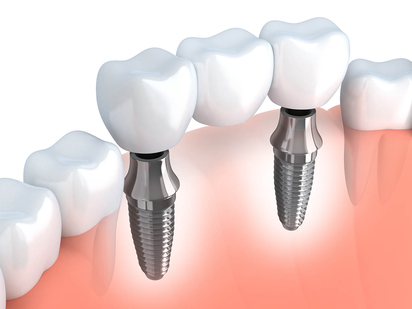 TOP 5 Questions About Dental Implants Answered 