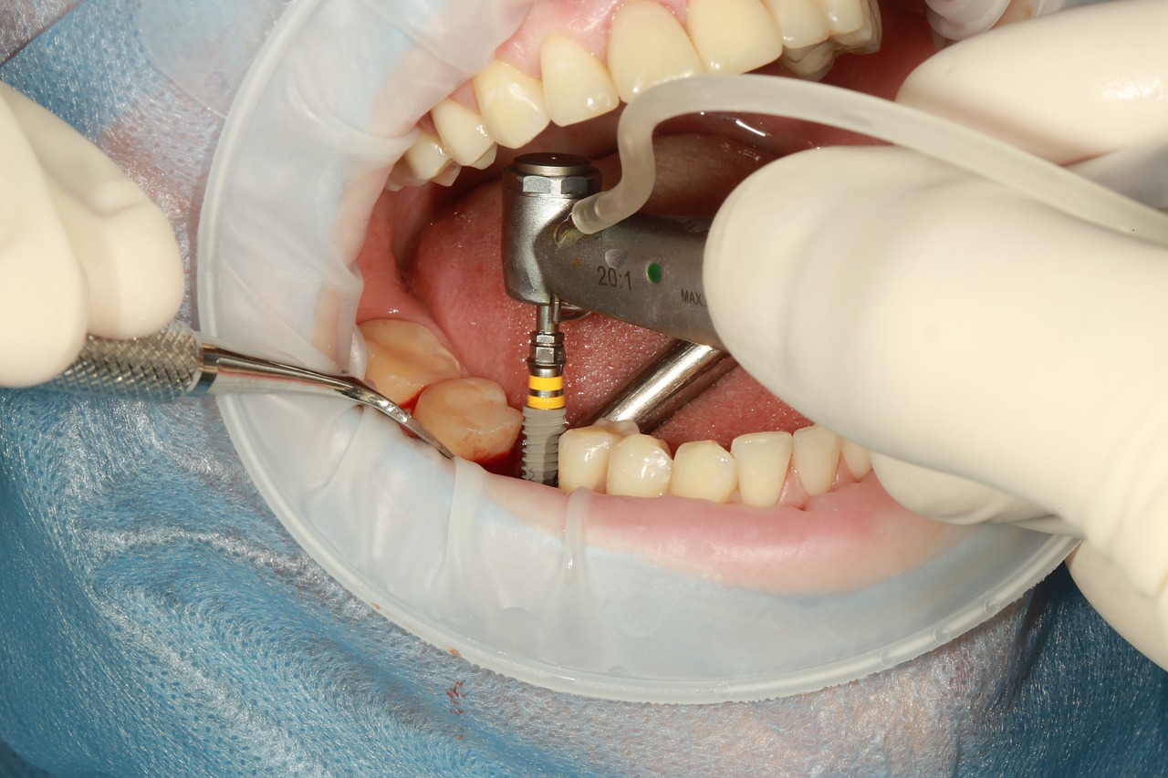 All On 4 Dental Implants Sydney