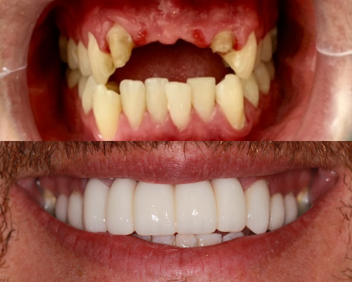dental implants and veneers parker co