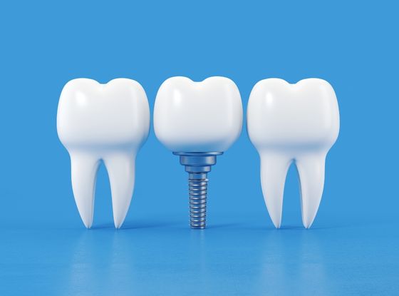 Dental Implant Recovery Process