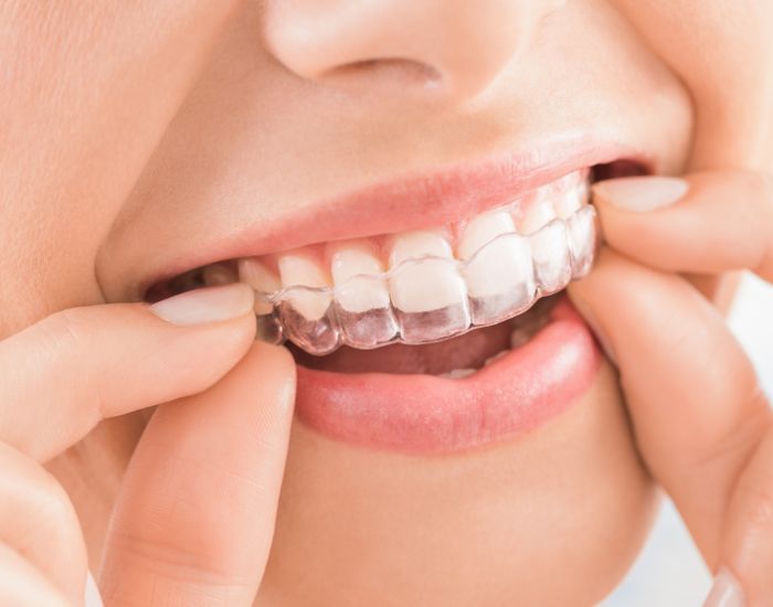 The Benefits of Invisalign for a Straighter Smile