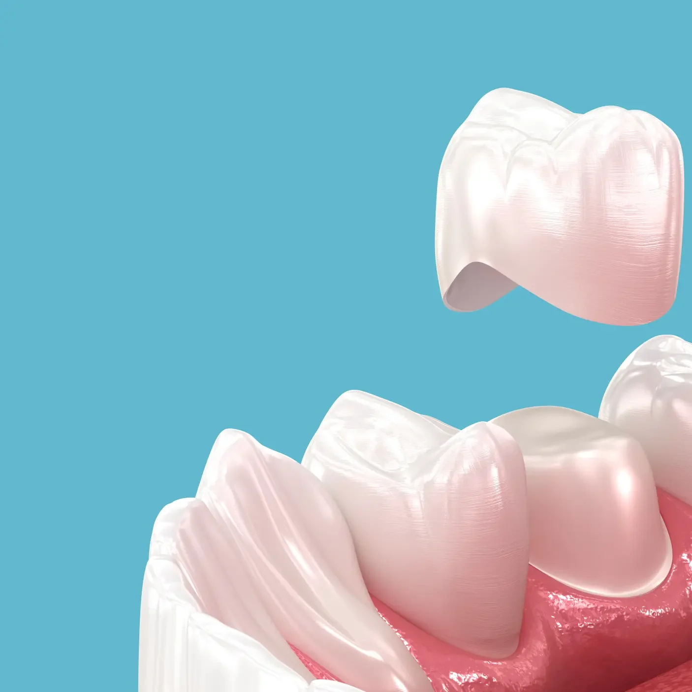 Dental crown being placed on a prepared tooth