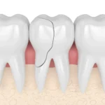 Cracked tooth, a dental emergency, shown in a close-up illustration.