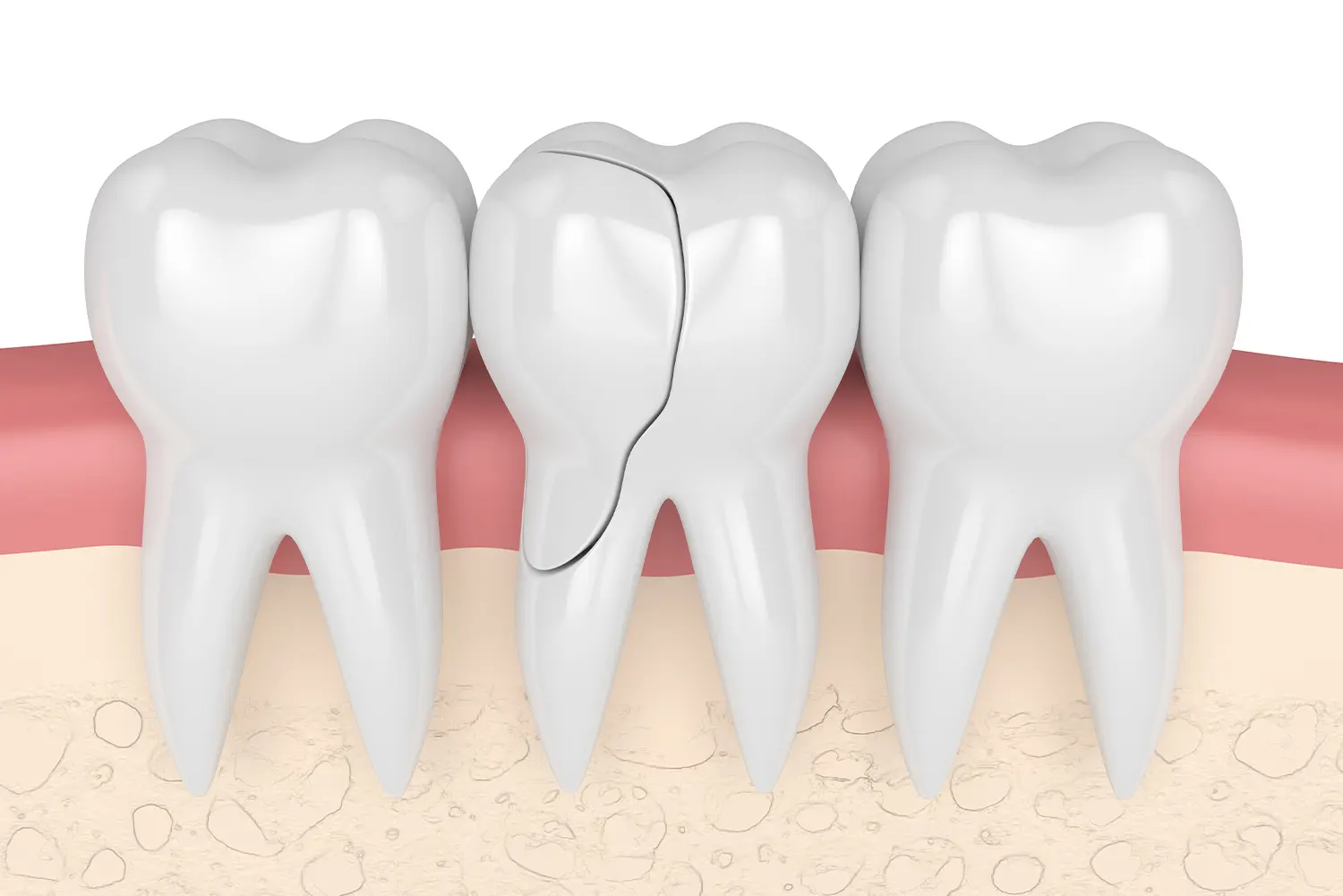 Cracked tooth, a dental emergency, shown in a close-up illustration.