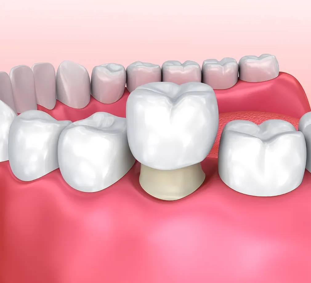 Dental crown being placed on a tooth, illustrating a dental crown procedure.